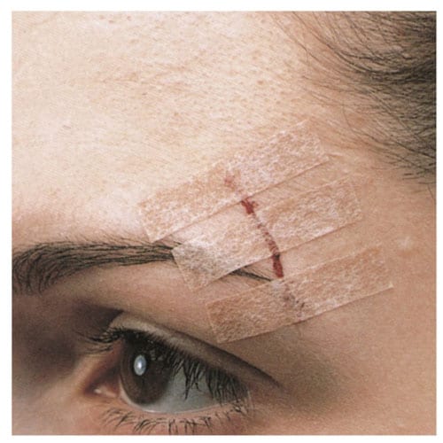 ステリストリップスキンクロージャー肌色 B1557