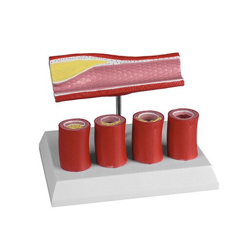 動脈硬化モデル