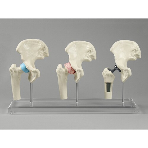 股関節インプラント術説明モデル