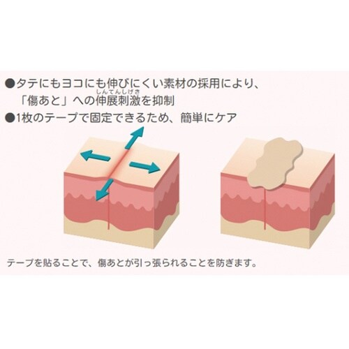 アトファイン傷あとケアテープ 50×11