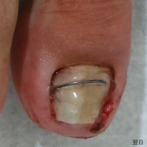 MT40 まきづめワイヤー