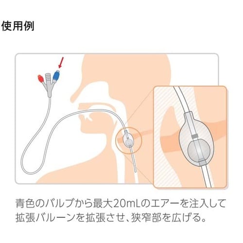 食道拡張用バルーンカテーテル 14Fr