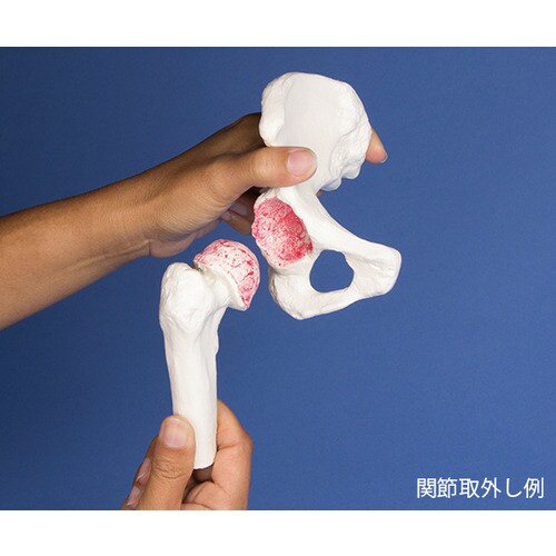 股関節インプラント術説明モデル
