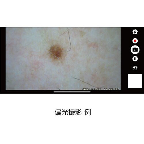 デジタルダーマトスコープ