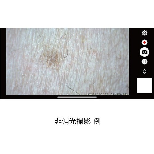 デジタルダーマトスコープ