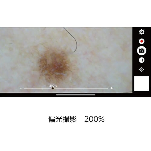デジタルダーマトスコープ